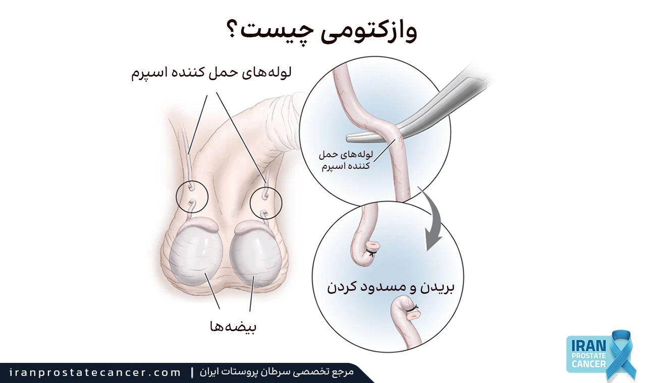 وازکتومی چیست؟ 