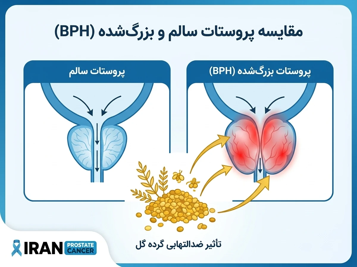 اینفوگرافیک مقایسه پروستات سالم با پروستات بزرگ شده و تأثیر ضدالتهابی گرده گل