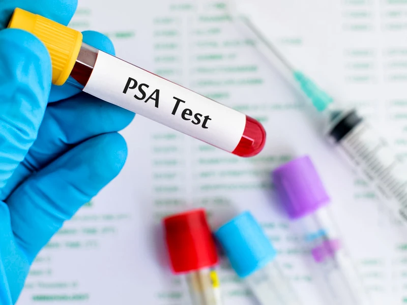 آزمایش PSA چیست؟