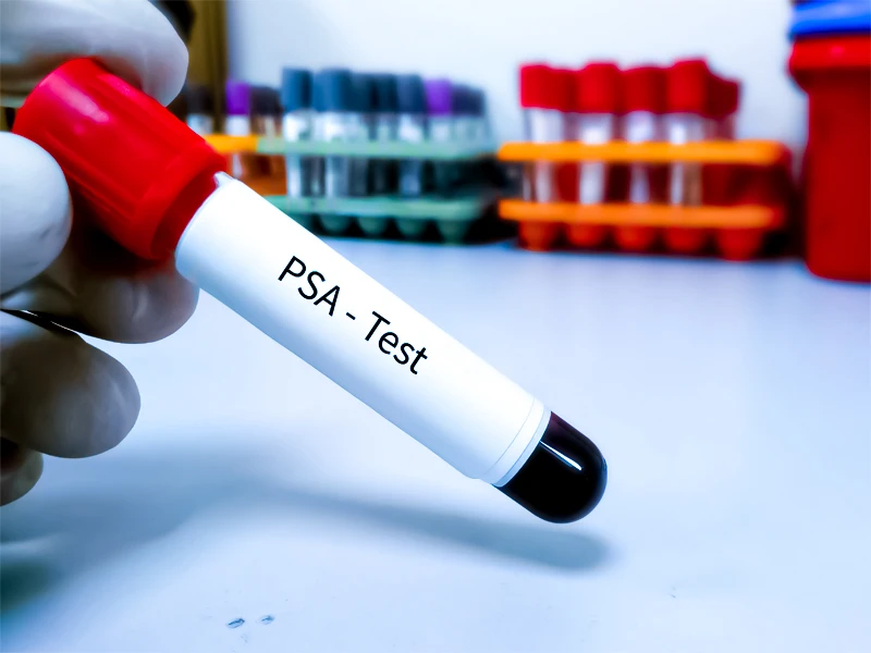 آزمایش خون PSA برای تشخیص سرطان